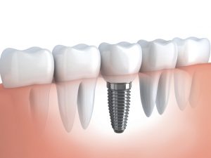 Dental 101: Preparing for a Dental Implant Procedure
