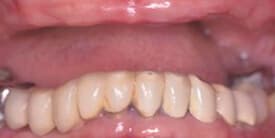 Family Dental Care - Crowns (Caps) - Dental Implants - Dentures & Partial Dentures - Porcelain Crowns (Caps) Before
